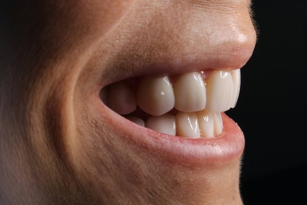 Full Mouth Rehabilitation