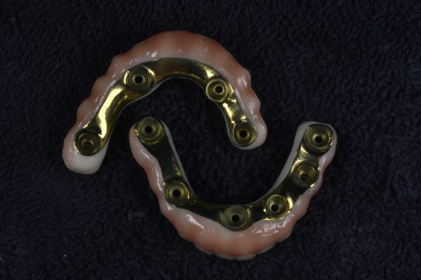 Titanium Arch Bars