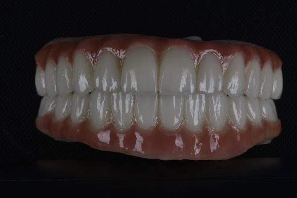 Implant-Supported Prosthetics