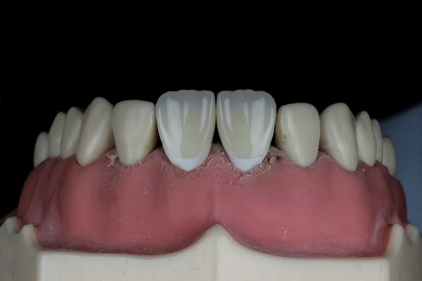 Emax Veneers