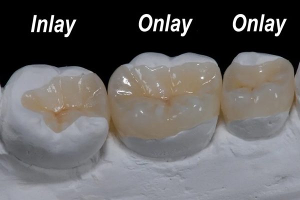 Inlays Onlays