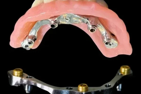 Implant bars